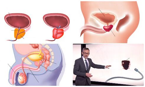 gesunde und kranke Prostata